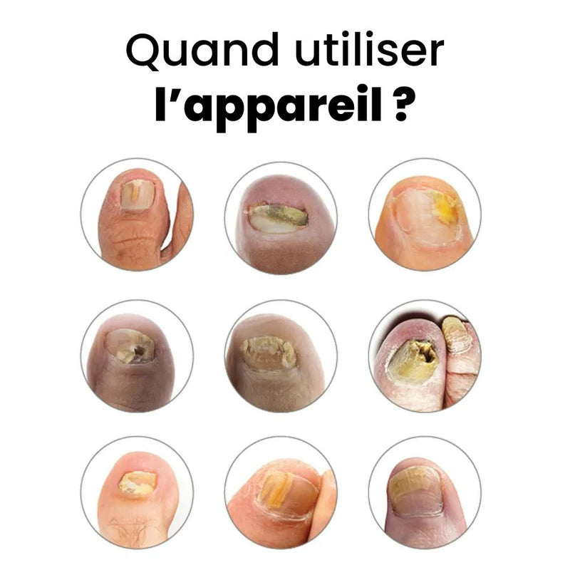 appareil de traitement des ongles