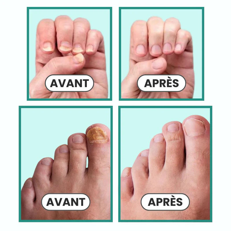 appareil de traitement des ongles