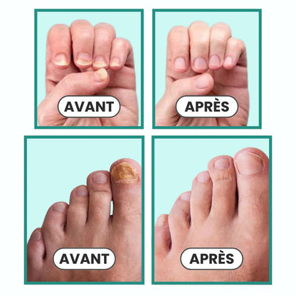 appareil de traitement des ongles